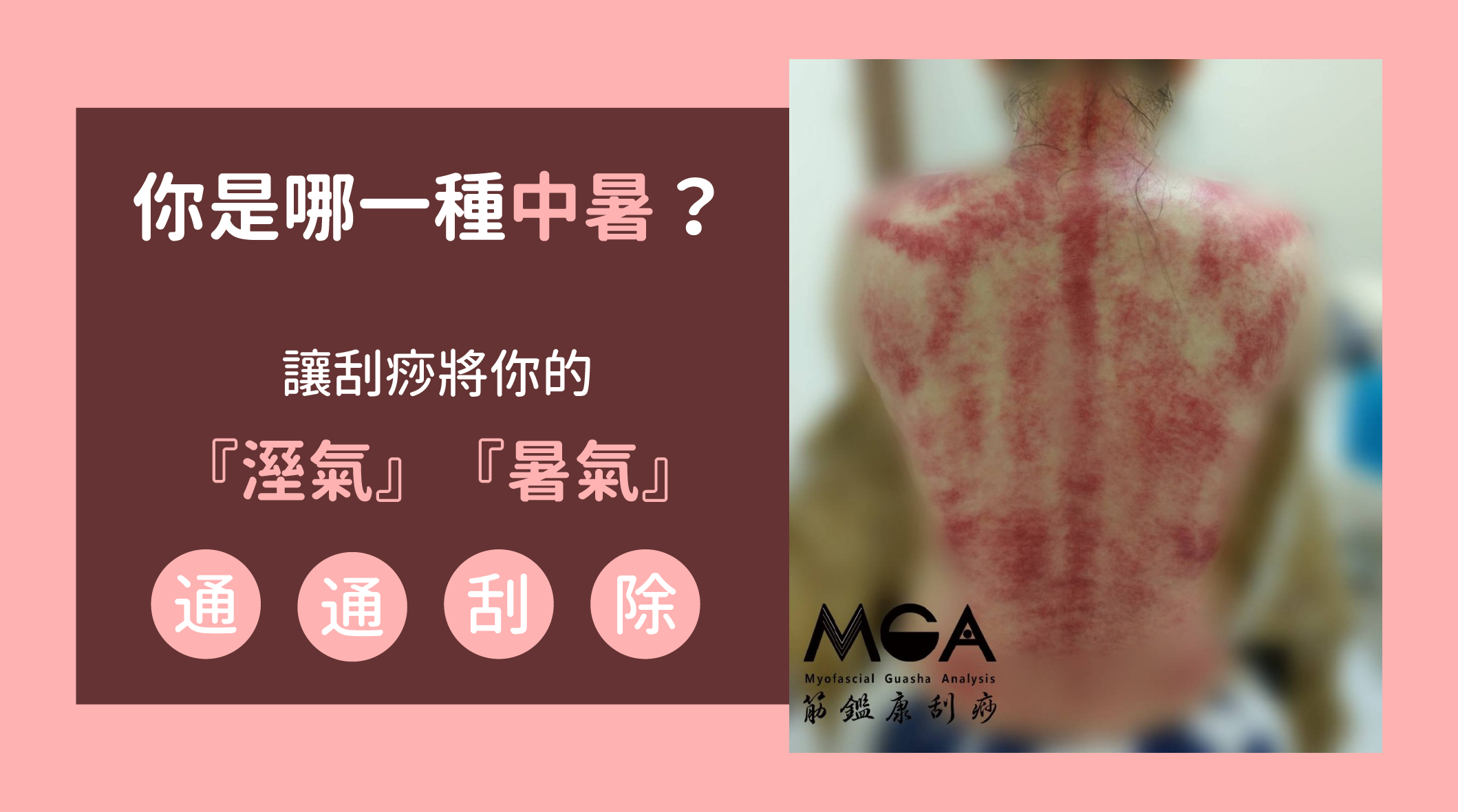 [刮痧知識] 你是哪一種中暑呢？讓刮痧將你的溼氣暑氣通通刮除！