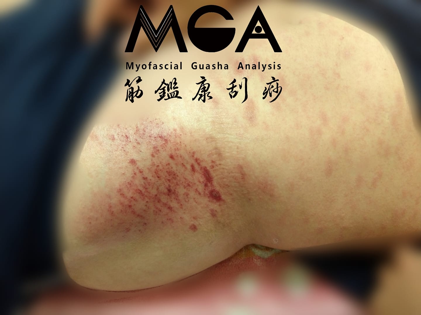 [刮痧案例] 透過刮痧改善過敏－玫瑰糠疹(Pityriasis rosea)