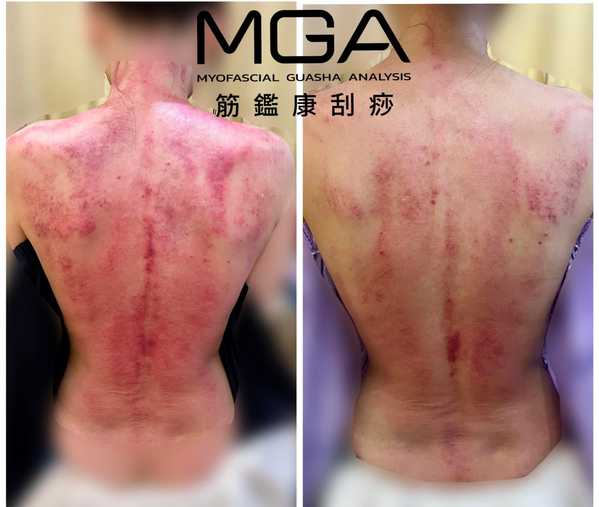 [刮痧案例] 缺血的人也是很難刮出痧