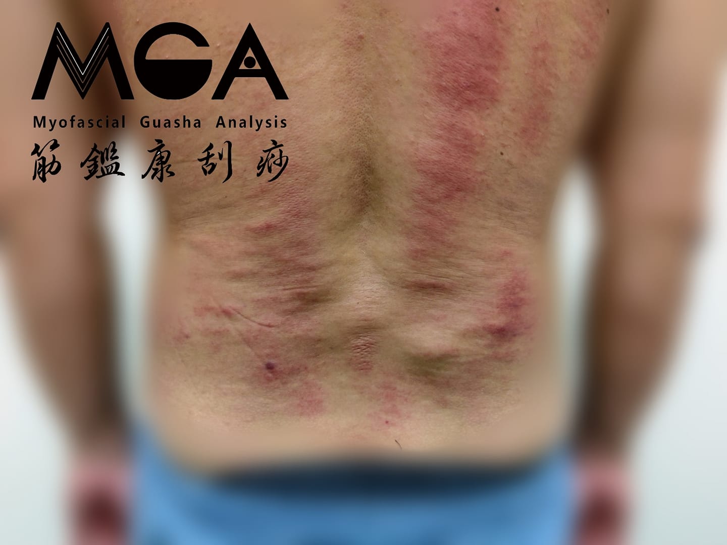[刮痧案例] 脂肪瘤