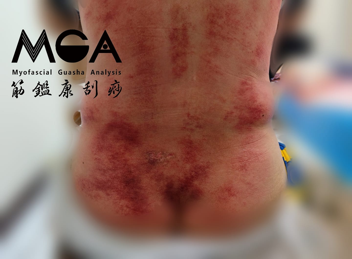 [刮痧案例] 男性常見的攝護腺問題