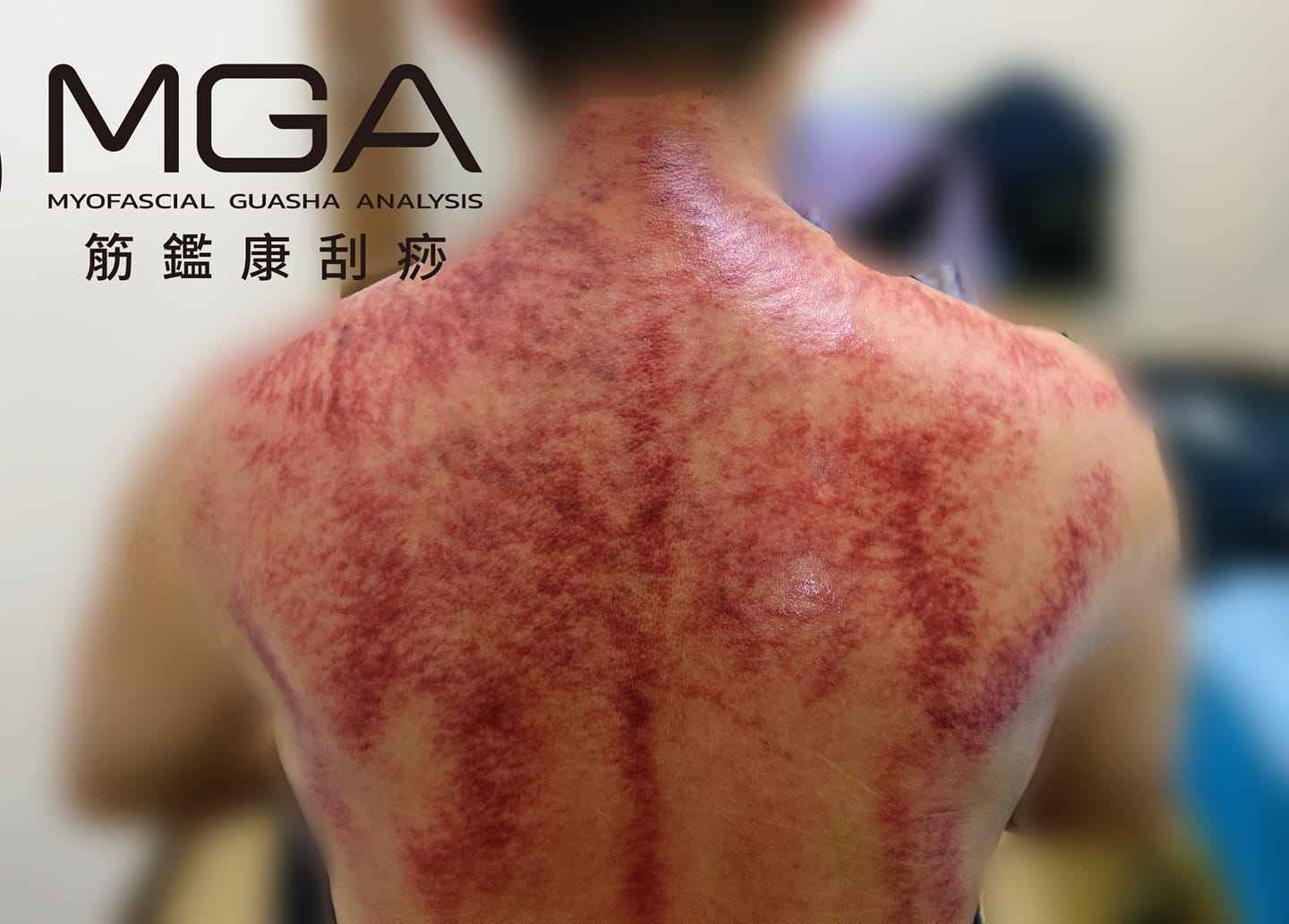［刮痧案例］塞翁失馬，焉知非福？ 過著養身的生活，但痧依然記錄著一切