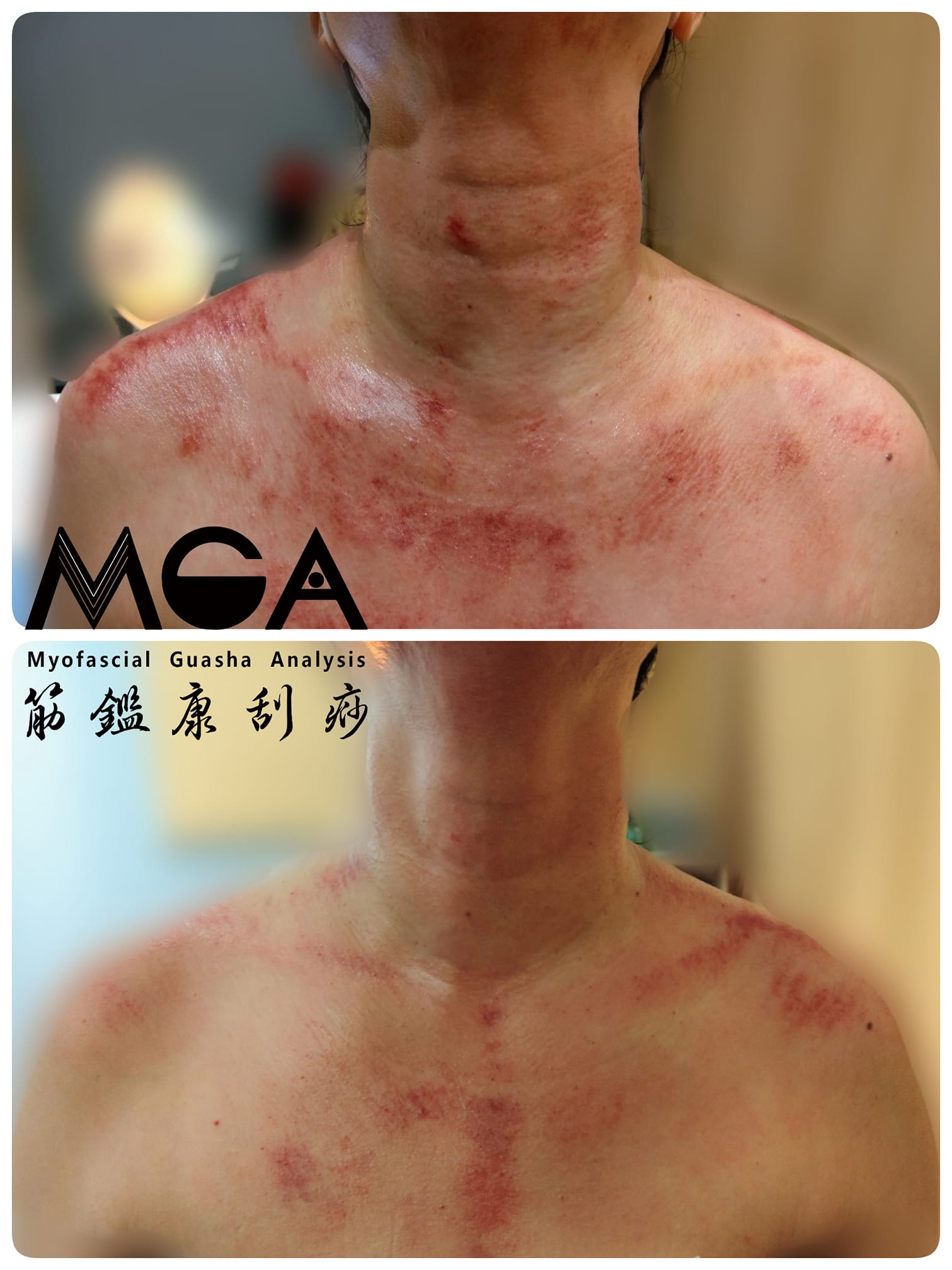 [刮痧案例] 甲狀腺、脖子腫，甚至吞嚥困難，運動刮痧幫你緩解