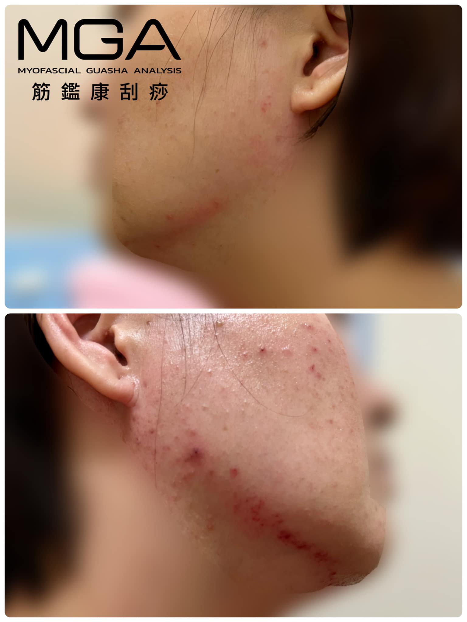 [刮痧案例] 淋巴與痘痘