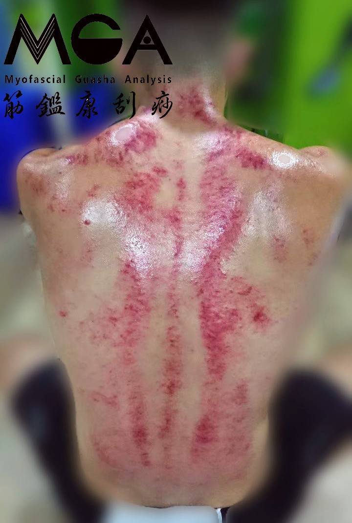 看痧圖說故事｜教練來刮痧 Part.1 -猜猜這位教練背部 哪一邊不舒服？