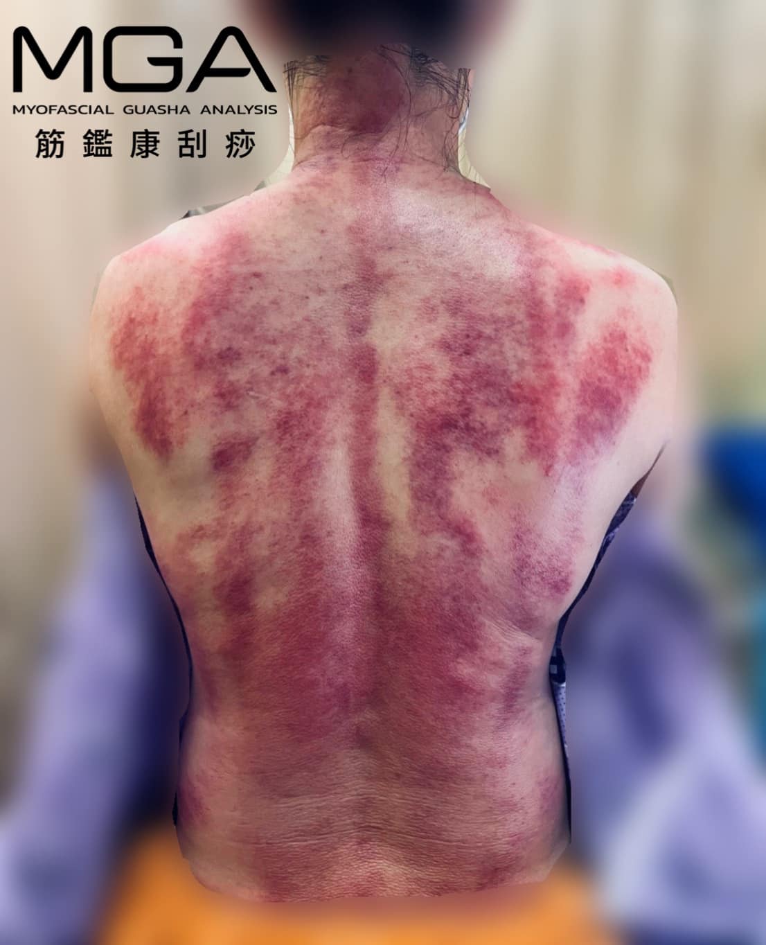 ［刮痧案例］你不是真的看開了而是最後選擇算了
