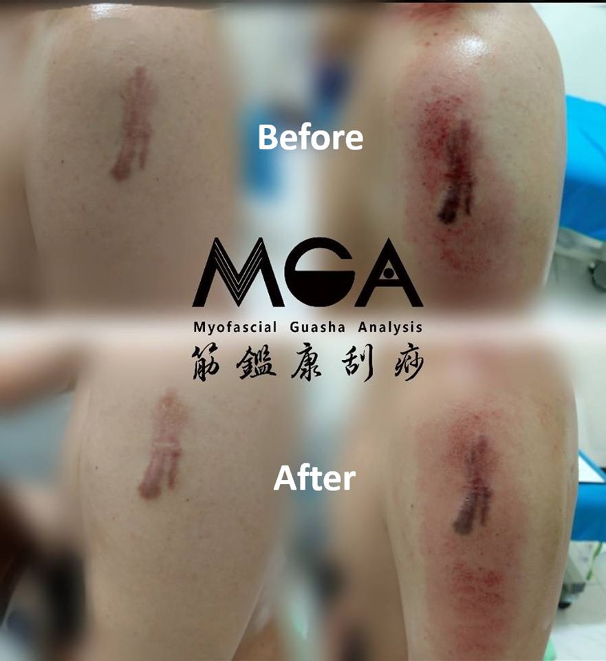 [刮痧案例] 蟹足腫也能靠刮痧改善？刮完後的變化