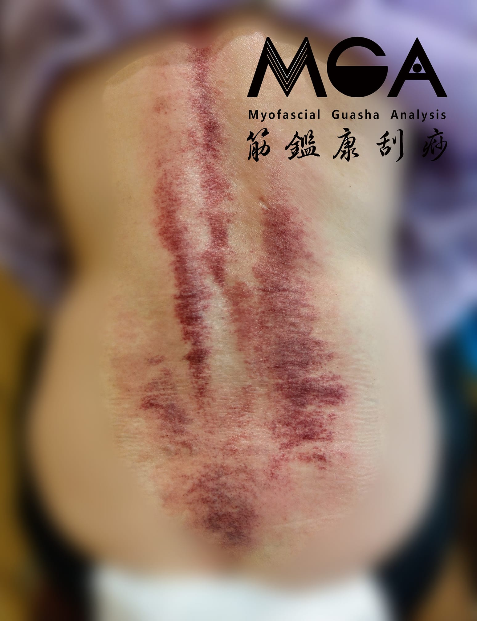 [刮痧案例] 下背緊繃不適，靠刮痧舒緩疲勞的身體