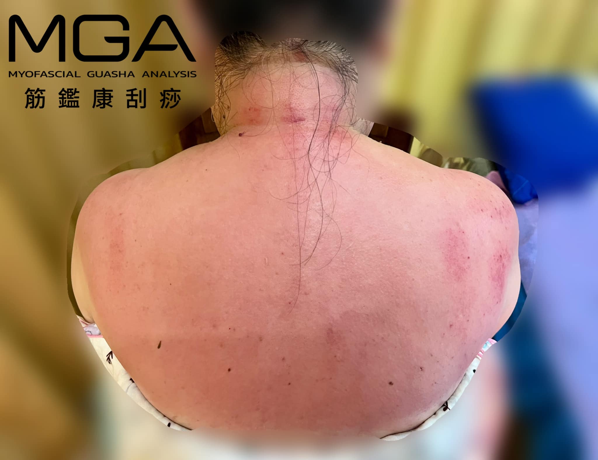 ［刮痧案例］石頭人，不是刻意、或願意變成石頭的