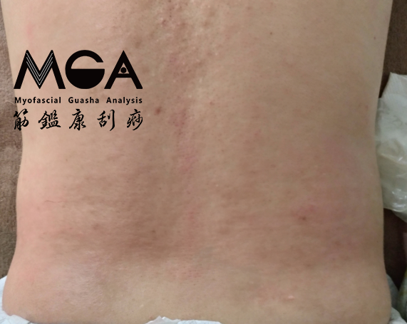 [刮痧案例] 五年以上的腰痛困擾，交給運動刮痧處理！
