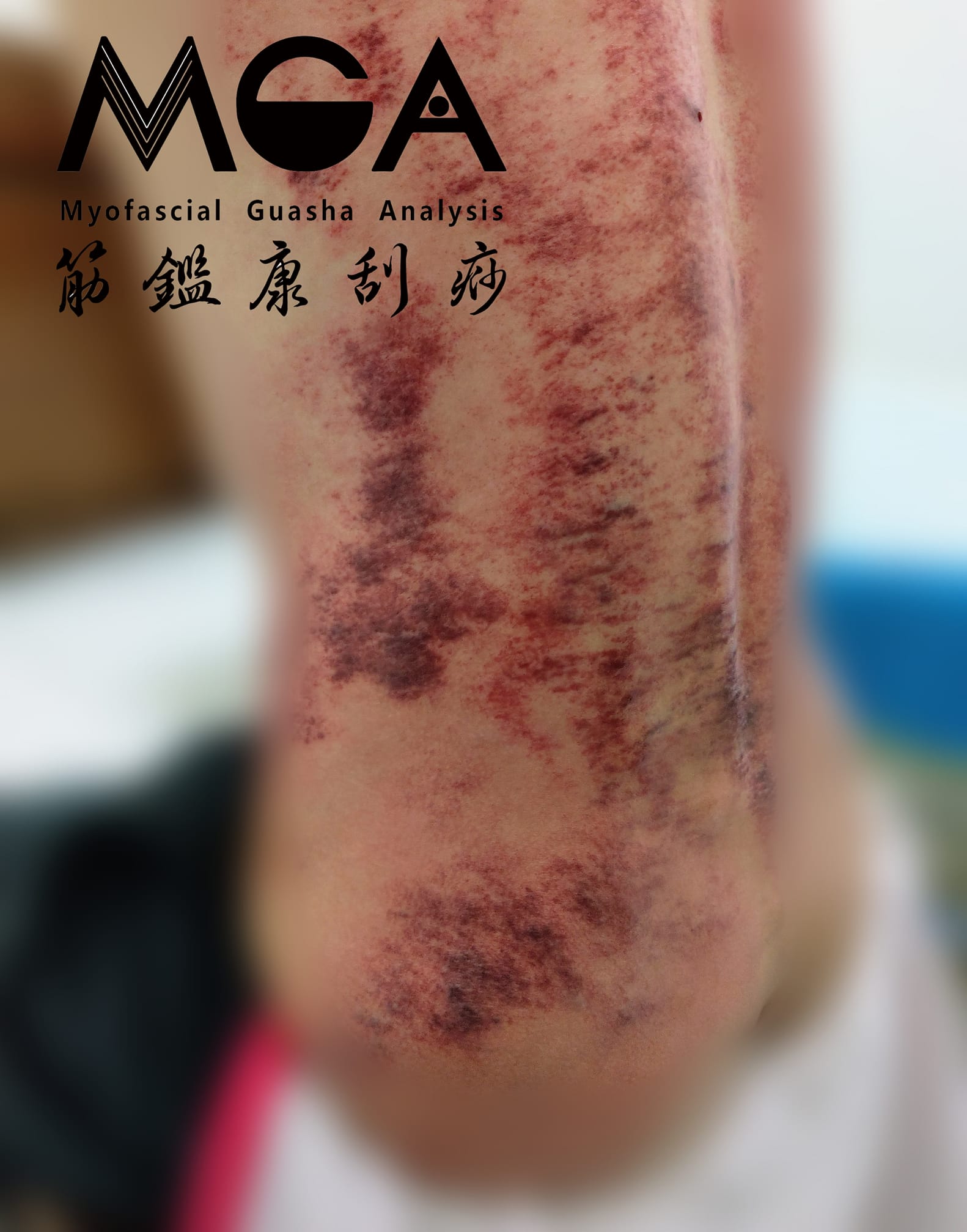 [刮痧案例] 拉傷腰而逞強不好好休息－腰痛與臀肌的關聯