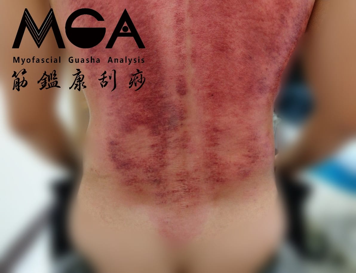 [刮痧案例] 重訓+補給品，你所吃進去的，真的都被好好吸收與代謝了嗎？