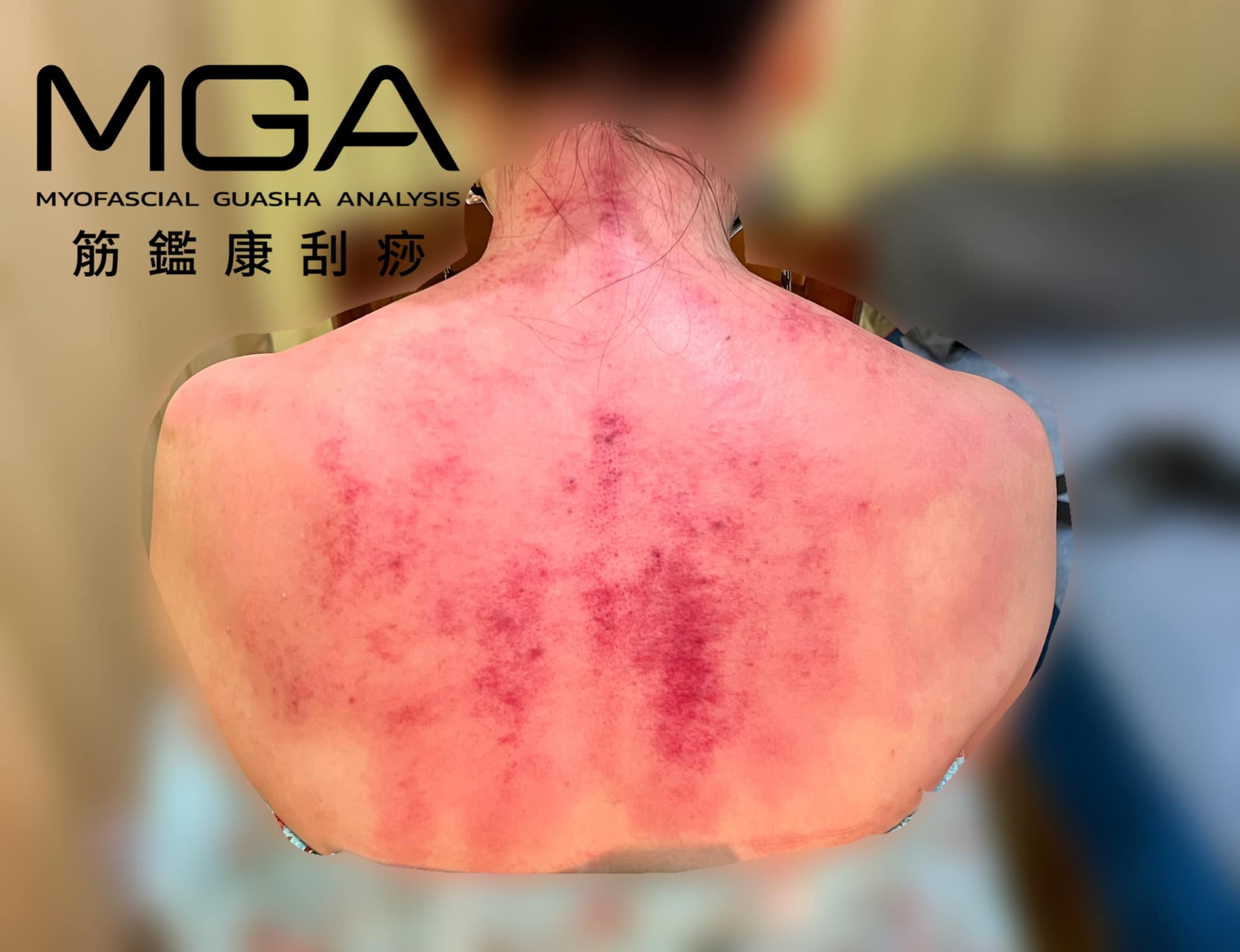 [刮痧案例] 膏肓痛！說不出口的背部緊繃