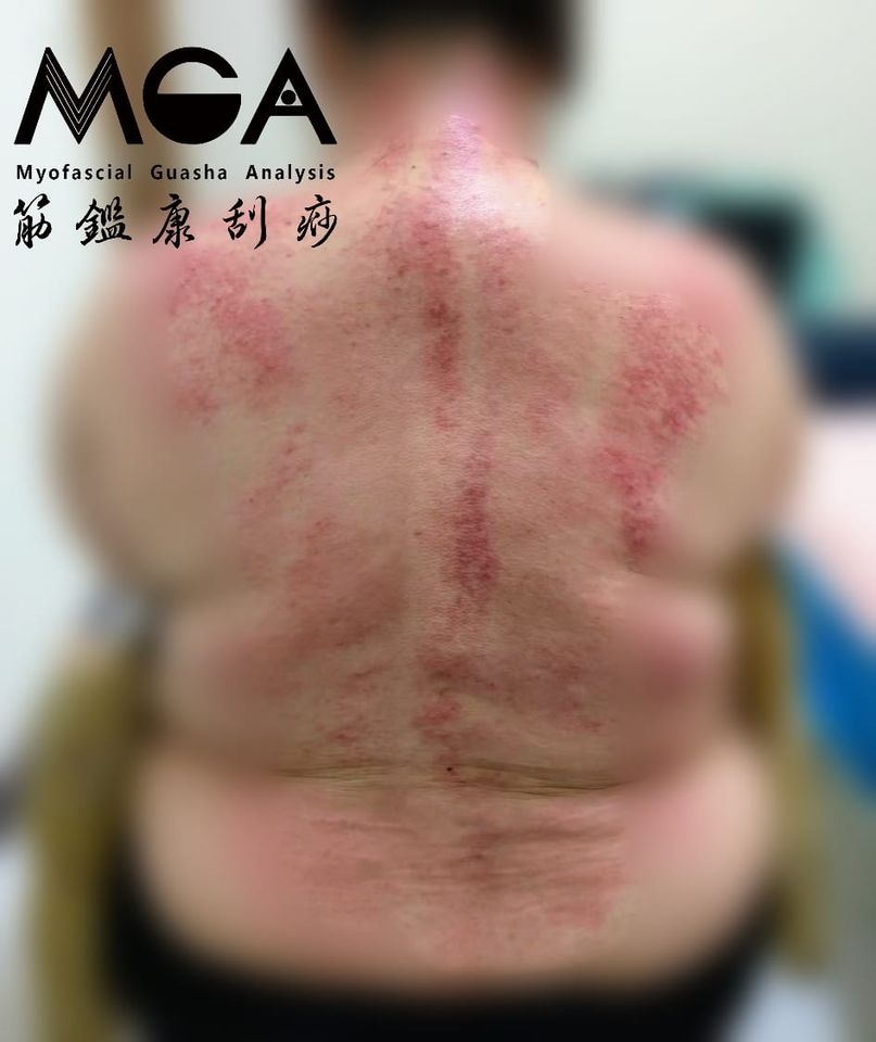 [刮痧案例] 調體質，除了吃中藥以外，刮痧也有幫助?!