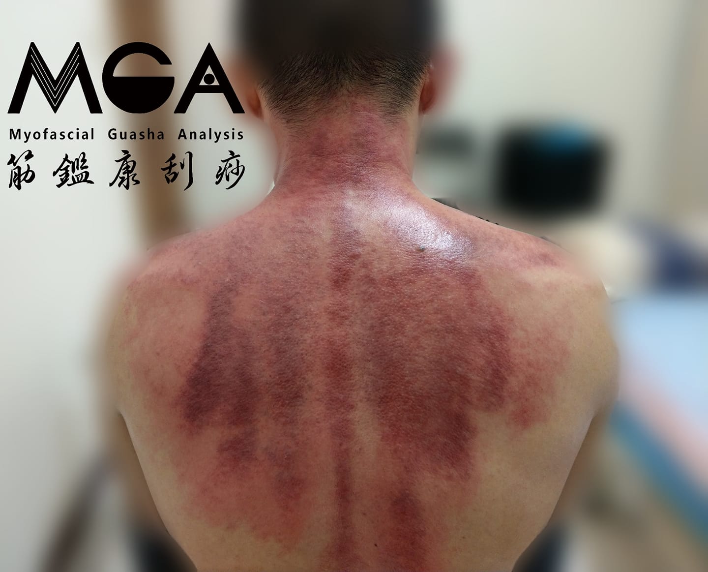 [刮痧案例] 胸悶、呼吸卡卡的？你沒注意到的內傷 痧都知道！
