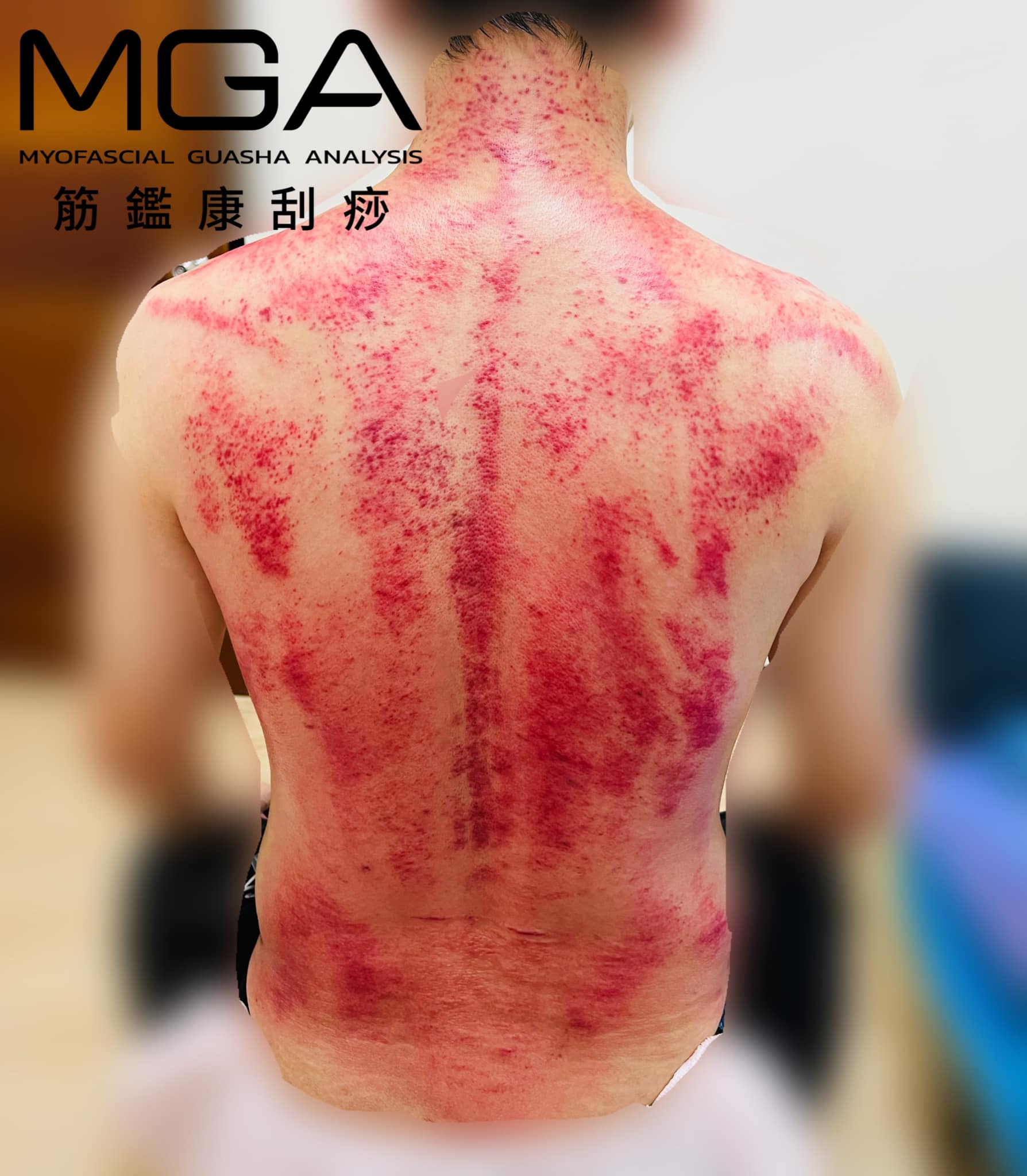 ［刮痧案例］最近的你，還好嗎？