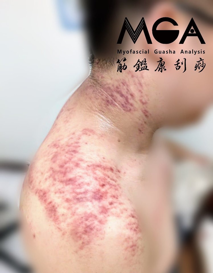[刮痧案例] 肩頸爆炸硬，來看看刮痧如何調理呢？