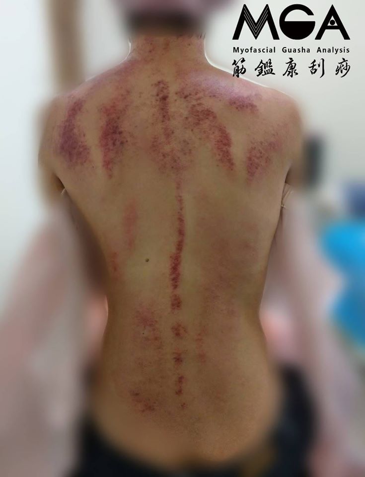 [刮痧案例] 脊柱側彎X肌理性刮痧會迸出什麼火花？