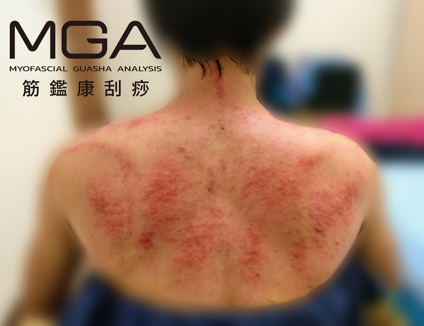 ［刮痧案例］心因性的痧圖與物理性有何差別，為何造成這種狀況呢？