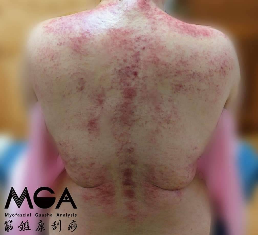 [刮痧案例] 運動卡關嗎？來看看MGA最得意的案例！