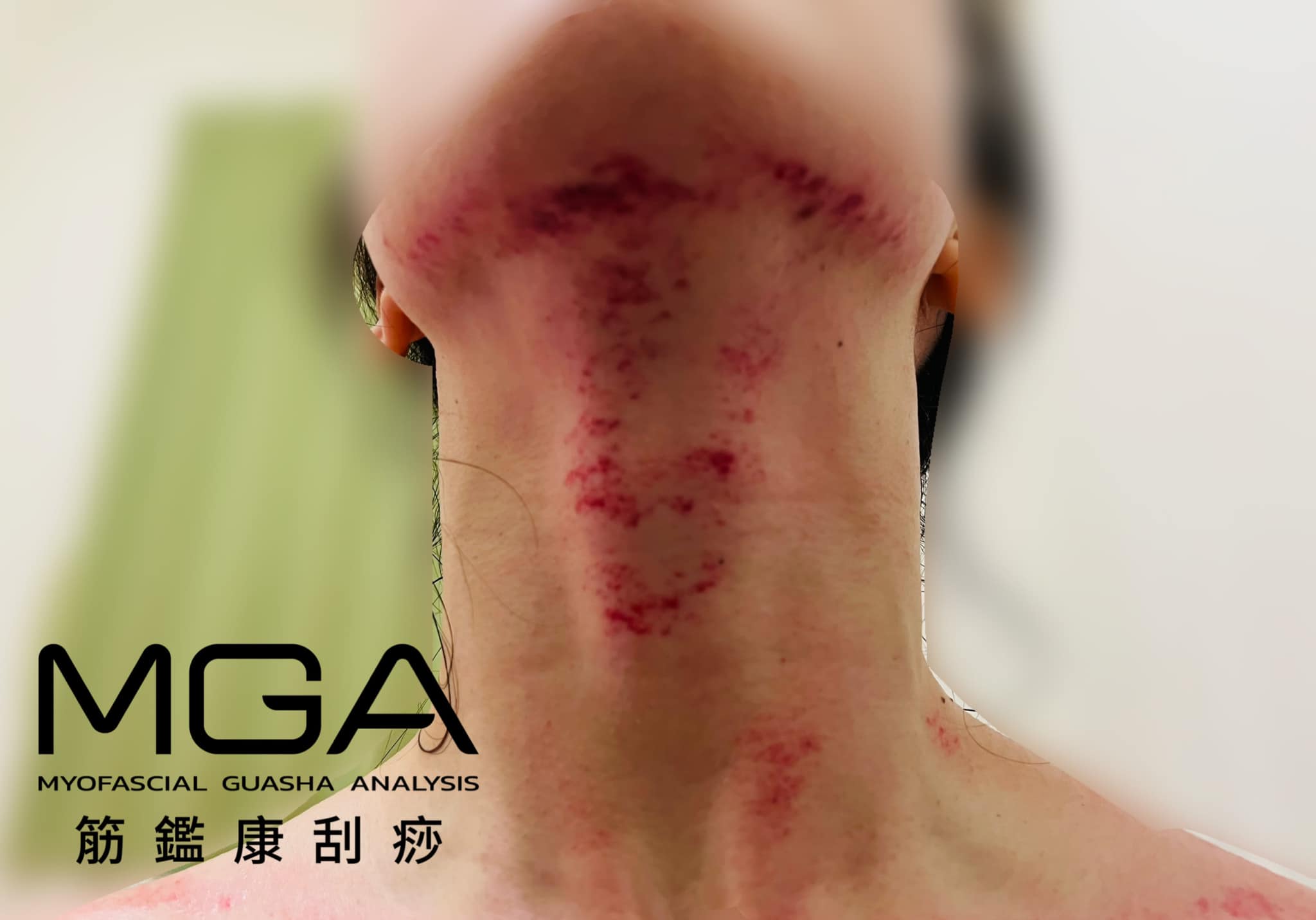 刮痧案例｜臉紅脖子粗，不是胖